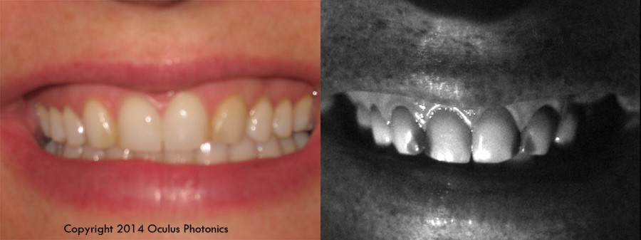 Watermark Chelsea's Teeth Vis-UV